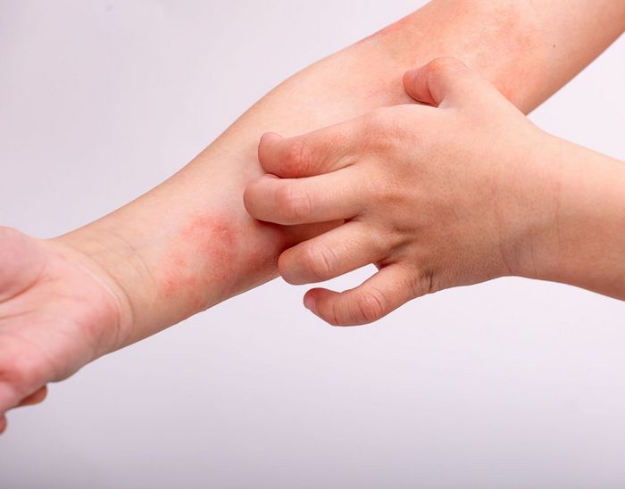 ΙΣΑ: 14 Σεπτεμβρίου – Παγκόσμια Ημέρα Ατοπικής Δερματίτιδας