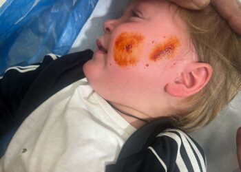 Αιτωλικό: ανήλικο κοριτσάκι δέχτηκε επίθεση από αδέσποτο σκύλο. Μεταφέρθηκε στο νοσοκομείο με τραύμα στο πρόσωπο