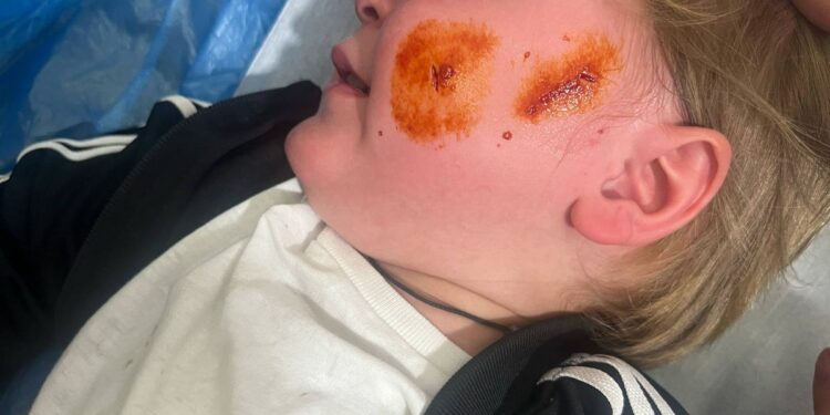 Αιτωλικό: ανήλικο κοριτσάκι δέχτηκε επίθεση από αδέσποτο σκύλο. Μεταφέρθηκε στο νοσοκομείο με τραύμα στο πρόσωπο