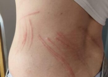 Αιτωλικό: νέα επίθεση σε 16χρονη από αδέσποτα σκυλιά