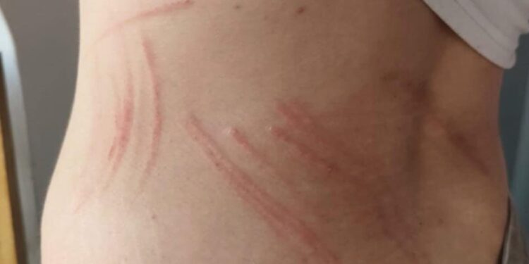 Αιτωλικό: νέα επίθεση σε 16χρονη από αδέσποτα σκυλιά